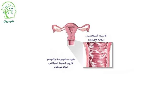 درمان عفونت واژن از شایع‌ترین بیماری‌های عفونی زنان