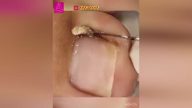 ویدیویی از جراحی ناخن فرو رفته در انگشت پا