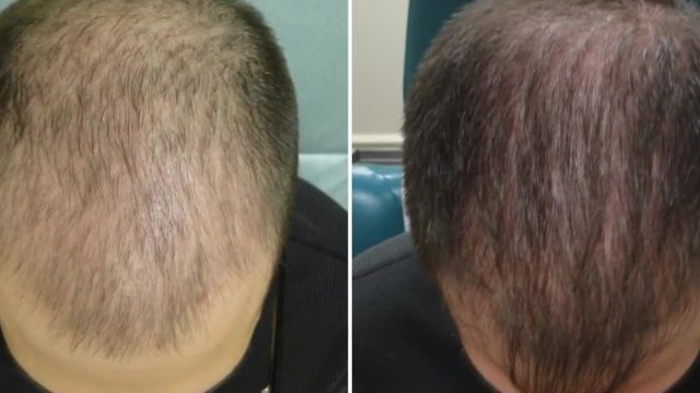بهترین روش رویش مجدد مو ( 100٪ تضمینی مورد تایید دکتر پوست و مو )