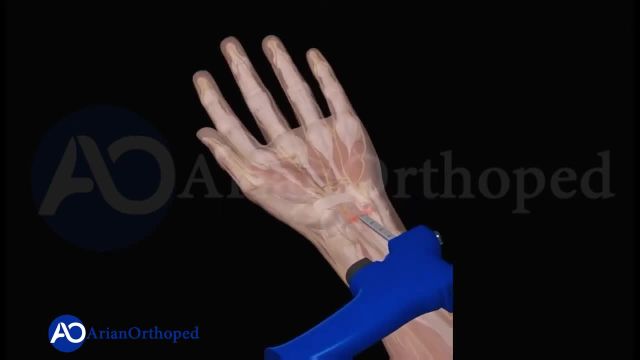 جراحی لیزری تنگی کانال مچ دست |  فشار عصب مدیان در ناحیه مچ دست