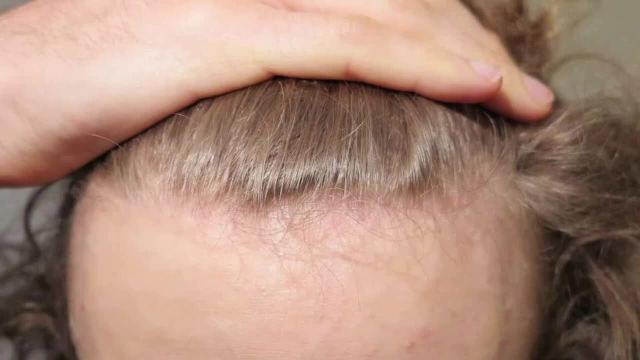 درمان ریزش و رشد مجدد مو با استفاده از مواد غذایی ساده و در دسترس