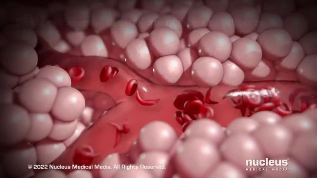 کم خونی سلول داسی شکل | ویدیو