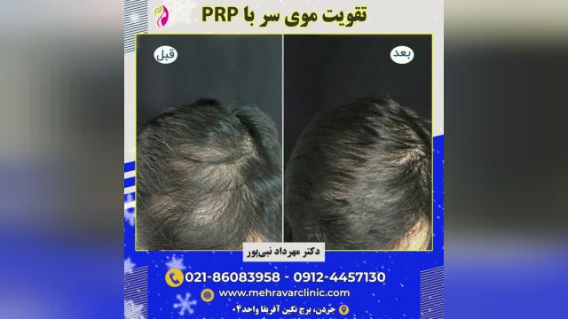 تقویت موی سر با PRP