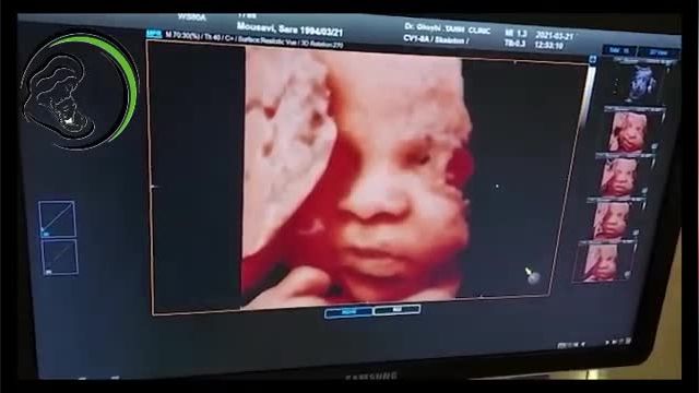 ویدئویی از سونوگرافى سه بعدی صورت جنین