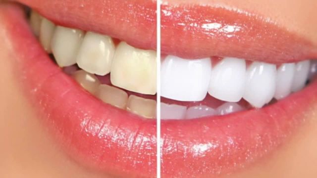 سفید کردن دندان ها با روش های سنتی | ویدیو
