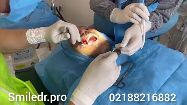 نمایش فیلم ایمپلنت دندان