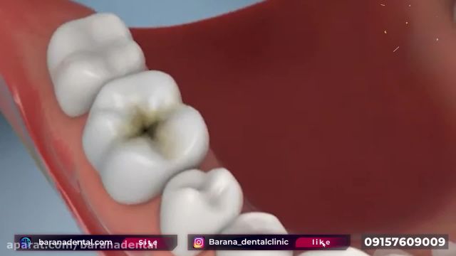 پر کردن دندان با کامپوزیت به چه صورت است؟