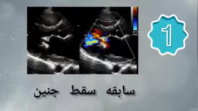 سونوگرافی تشخیص ساک حاملگی | در دوران بارداری چه سونوگرافی هایی ضروری است ؟
