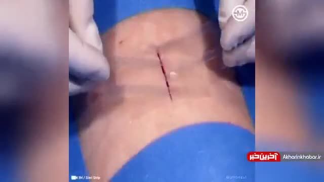 نوار چسب زخم های باز بدون نیاز به بخیه | ویدیو
