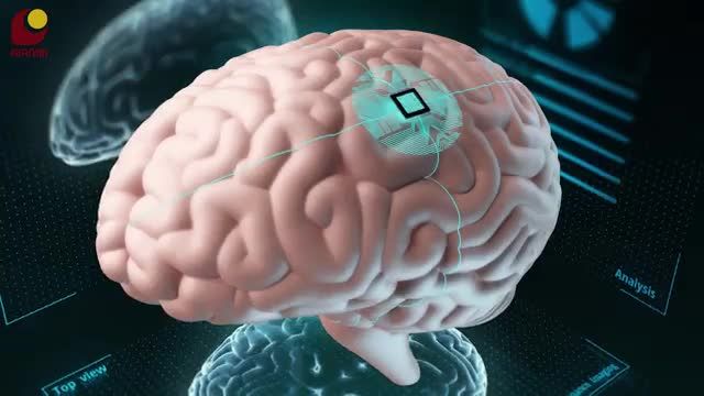 ایمپلنت مغزی نیورا لینک چگونه کار میکند؟