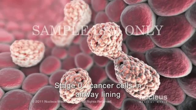 سلول های غیر کوچک مرحله بندی سرطان ریه