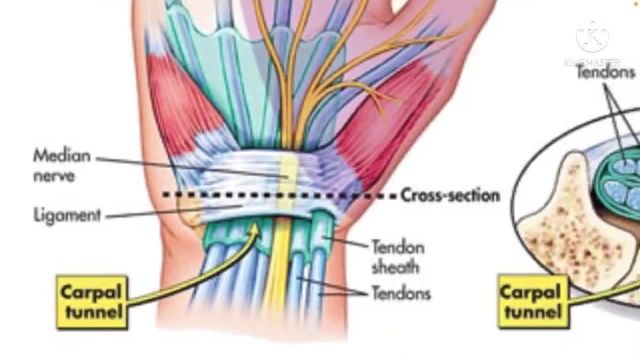 بررسی کامل و جامع درد مچ دست و سندرم تونل کارپ (carpal tunnel syndrome)