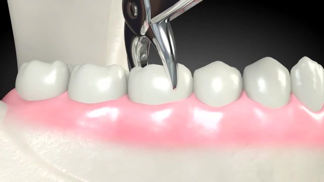 چگونگی پیوند استخوان فک پایین برای ایمپلنت دندان