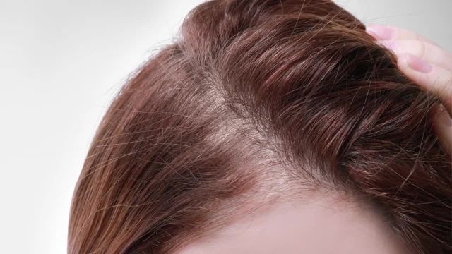 دلایل اصلی ریزش مو | درمان و جلوگیری از ریزش مو