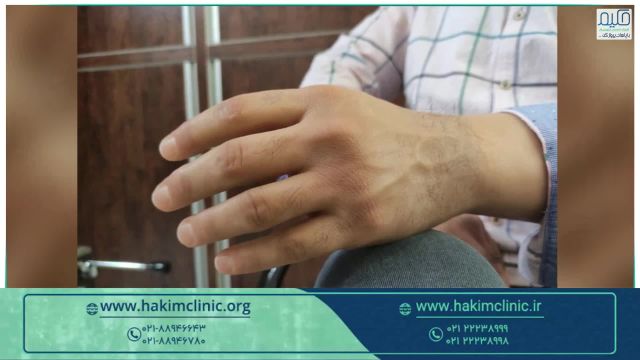 پروتز زیبایی دست - سیلیکونی زیر آرنج