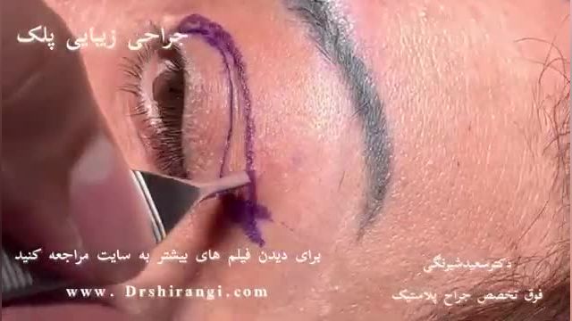 فیلم کامل جراحی پلک در مطب دکتر سعید شیرنگی
