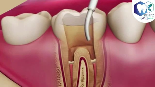 عصب کشی دندان (درمان ریشه دندان)