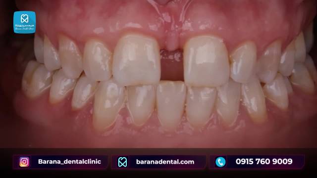 ترکیب ارتودنسی و کامپوزیت و تاثیر آن در برطرف شدن فاصله بین دندانی