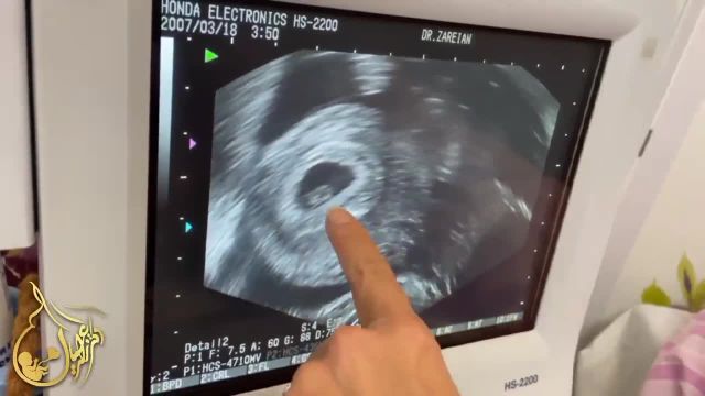 بارداری با آی وی اف با وجود تشخیص هیپومنوره هیپوتالامیکی