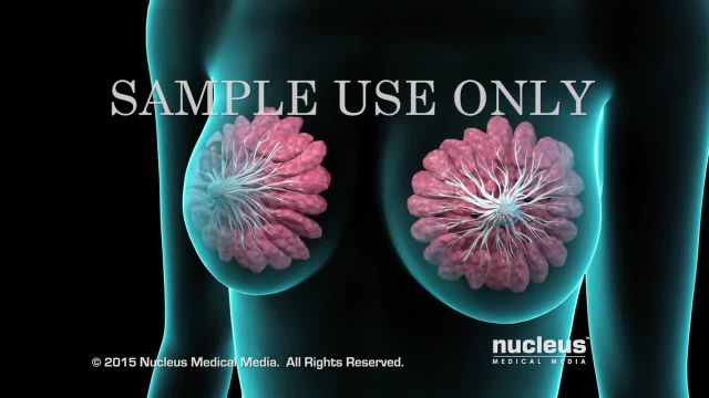 سرطان سینه | بیوپسی پستان