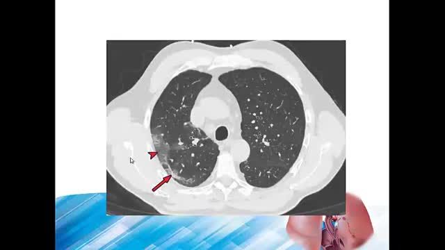 درگیری ریه در کرونا | Lung Involvement in covid 19