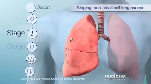 سرطان ریه چگونه بر بدن تأثیر می گذارد؟ | ویدیو