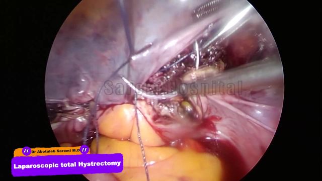 Laparoscopic total Hystrectomy