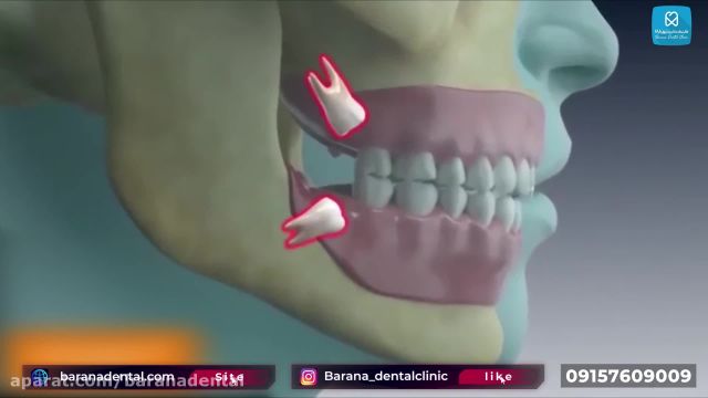 فیلم جراحی دندان عقل
