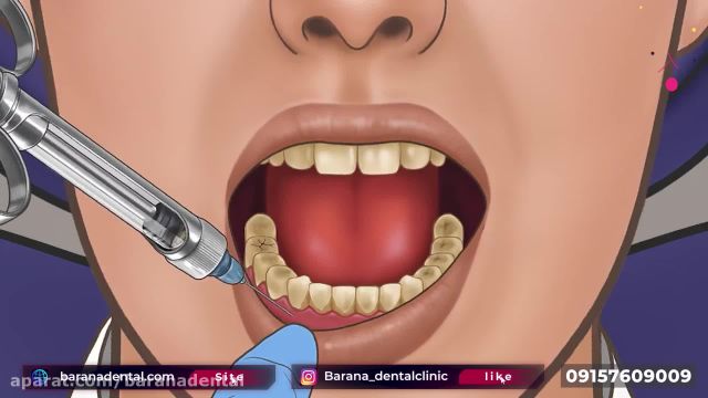 جرم گیری دندان چگونه انجام می شود؟