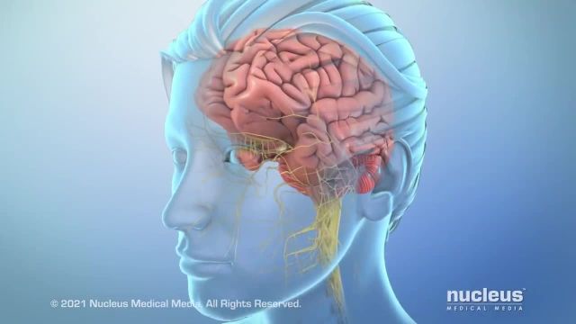 سردرد میگرنی چیست؟ | ویدیو