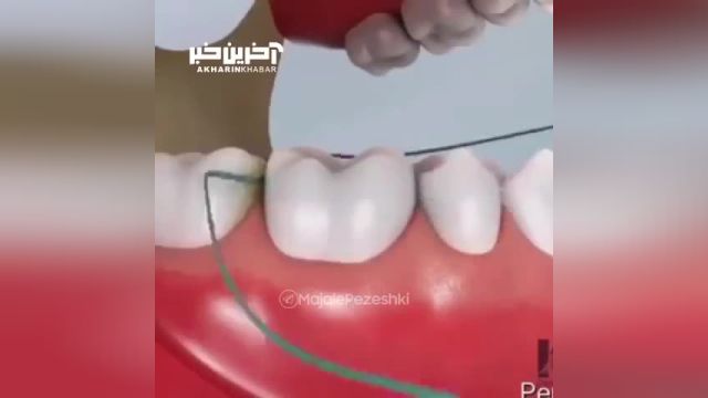 آموزش نحوه صحیح نخ دندان کشیدن (ویدئو)