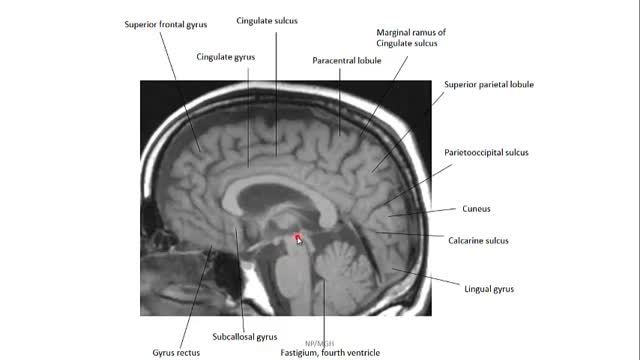 آناتومی مقطعی مغز | آموزش آناتومی مقطعی بدن | جلسه هشتم