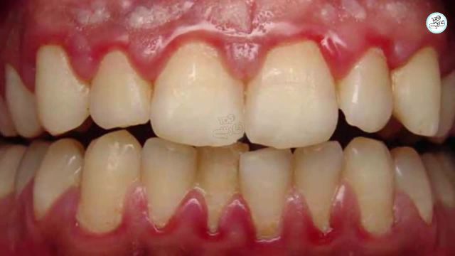 آیا دندان عقل را باید کشید؟ | کاربرد دندان عقل چیست؟