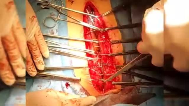 عمل جراحی CABG | نحوه بخیه زدن سه لایه پوست در جراحی قلب باز