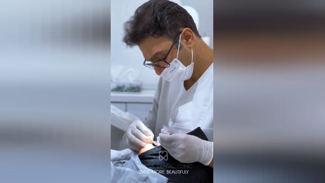 عصب کشی در دندانپزشکی بارانا