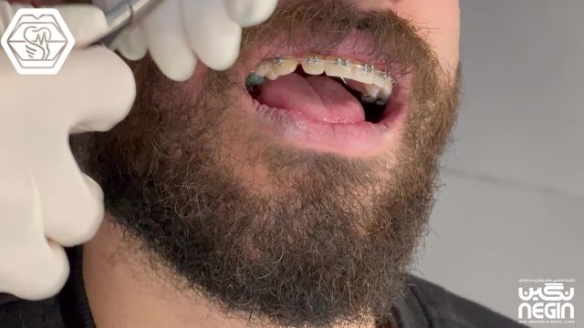 تعویض اورینگ ارتودنسی دندان-دکتر نیلوفر آزاده