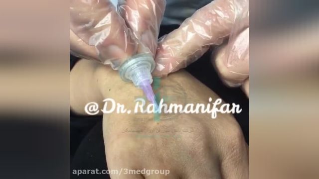 رفع چین و چروک پشت دست با دستگاه پزشکی Carboxy Therapy