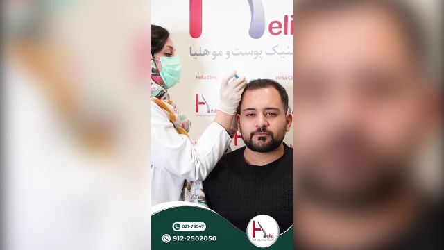 مزوتراپی با کوکتل Revitacare | راهکاری برای رشد مو دائمی