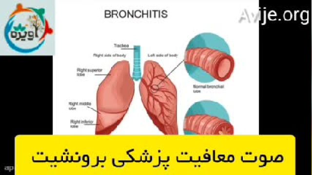 چطوری معافیت سربازی برونشیت بگیرم؟