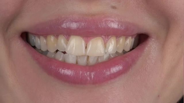 نمونه کار بلیچینگ دندان در کلینیک بارانا