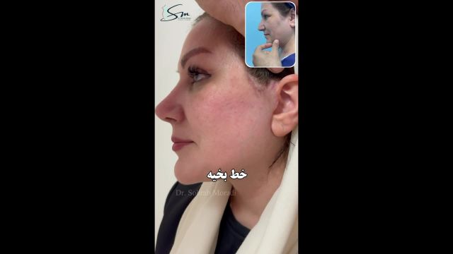 قبل و بعد یه نفره واقعا؟ - رضایت زیباجو از جراحی لیفت صورت