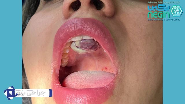 جراحی بیوبسی - دکتر نگین اثنی عشری - متخصص بیماری دهان، فک و صورت