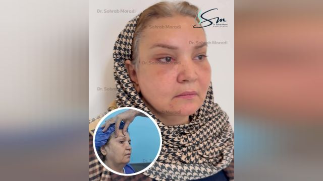 جراحی لیفت صورت - بهترین جراح زیبایی در تهران