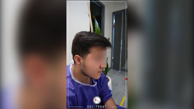 کاشت ریش طبیعی با تراکم بالا و ظاهری زیبا