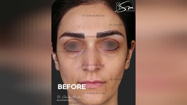 جراحة التجميل الأنف في طهران - دكتور مرادي