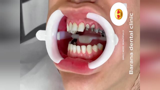 انجام روکش و لمینت دندان در  دندانپزشکی مشهد