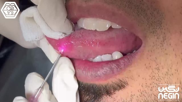 برداشتن ضایعه زبان با لیزر - توسط دکتر نگین اثنی عشری