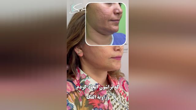 جراحی لیفت صورت و بلفاروپلاستی - دکتر سهراب مرادی