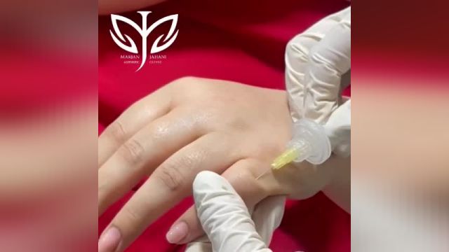 رفع چین و چروک پشت دست با Carboxy Therapy