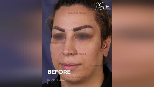 عملية تجميل الأنف في طهران - دكتور مرادي